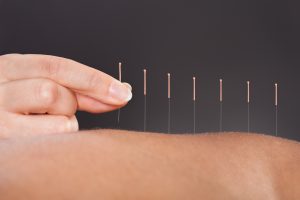 Dry needling by physio in Wanaka