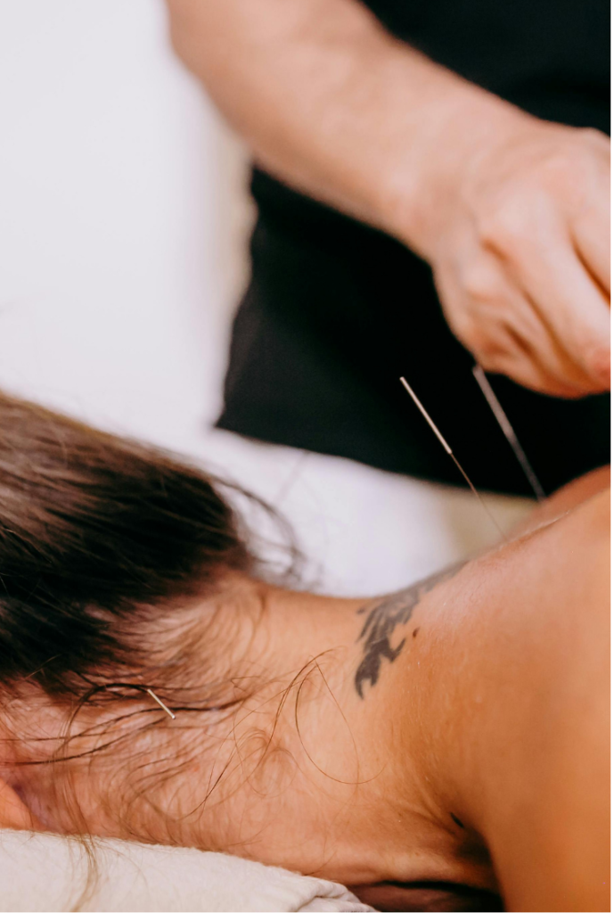 Dry needling and acupuncture treatment in Wanaka